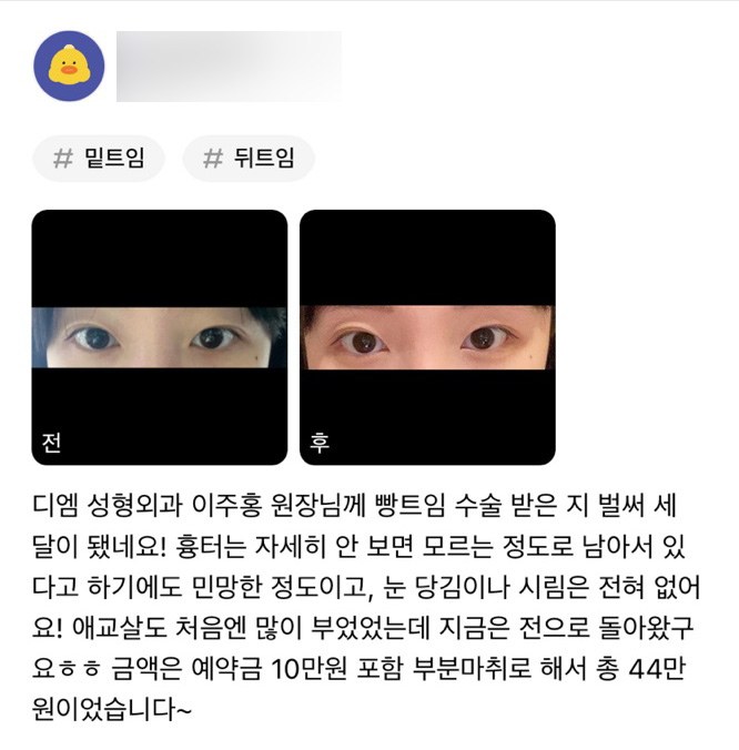 빵트임 후기."흉터도 거의없는편이고, 눈에 이물감도 전혀 없어요!" 관련 이미지 1