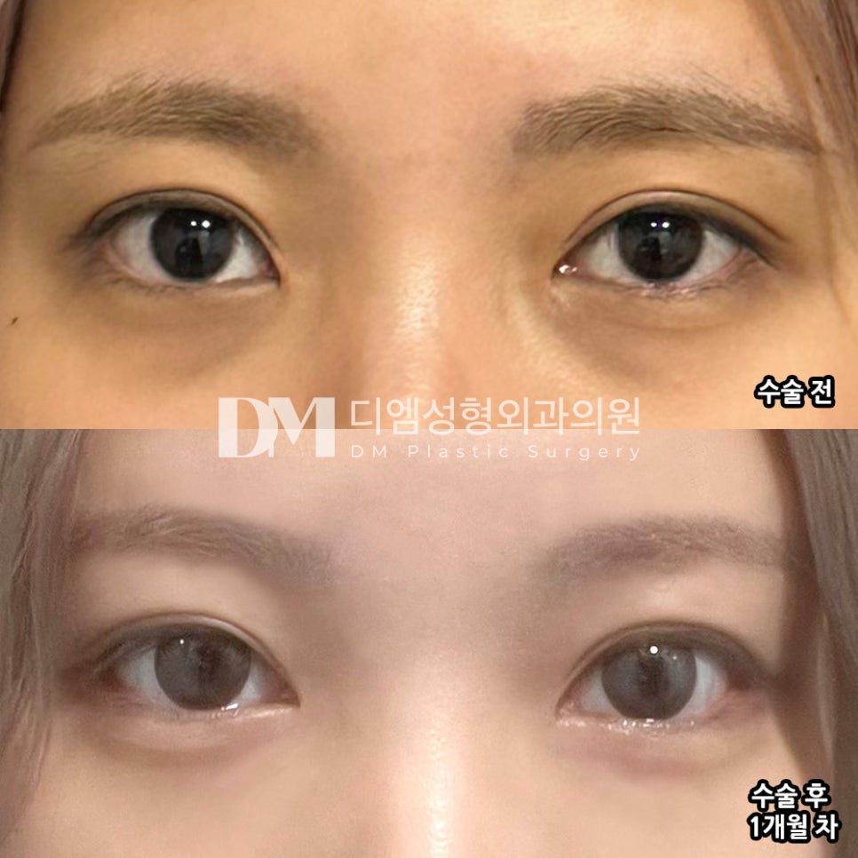 Ppangtwin Review. "The swelling has gone down completely, and the line has settled in naturally, so I think it became exactly the impression I wanted." image 2