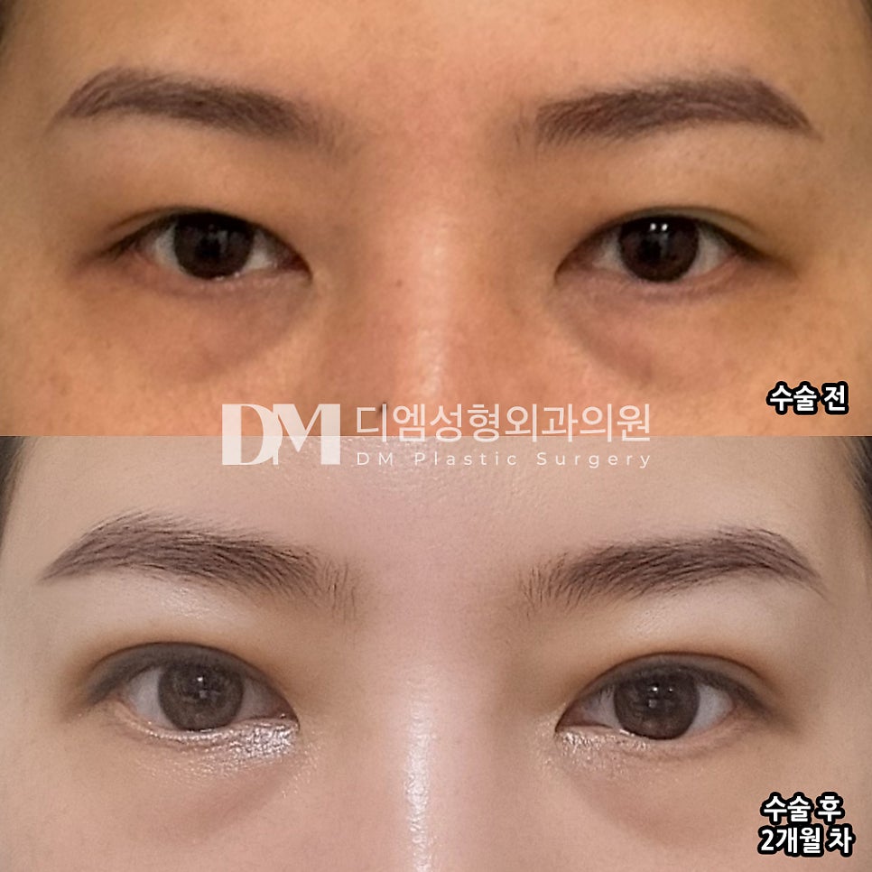 상안검 후기."눈쳐짐이 고민이었는데 너무 잘 되서 빨리 할걸 후회되네요" 관련 이미지 2
