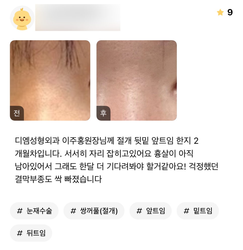 눈성형 후기."서서히 자리잡는 중이에요!" 관련 이미지 1