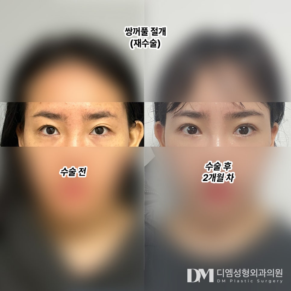 눈재수술 후기."꼼꼼하고 빠르게 잘 해주셨어요!" 관련 이미지 2