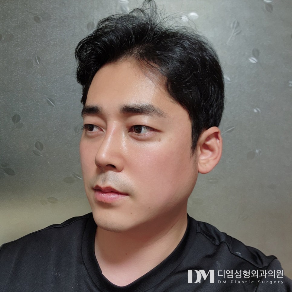 매부리코 , 미적 개선과 기능 개선을 동시에 ! 관련 이미지 10