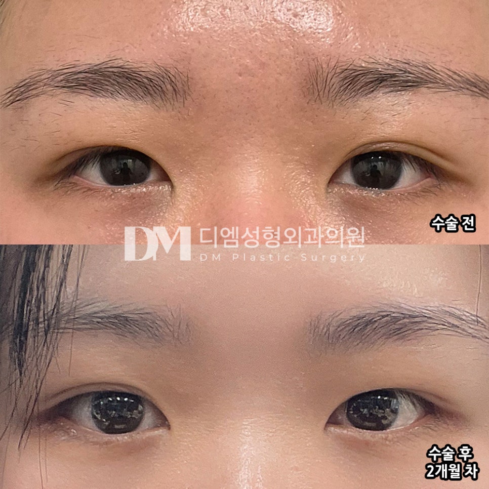 디엠 빵트임 수술후기, &ldquo;은은하게 눈이 트여 보이는 느낌이라 만족 중이에요!&rdquo; 관련 이미지 2