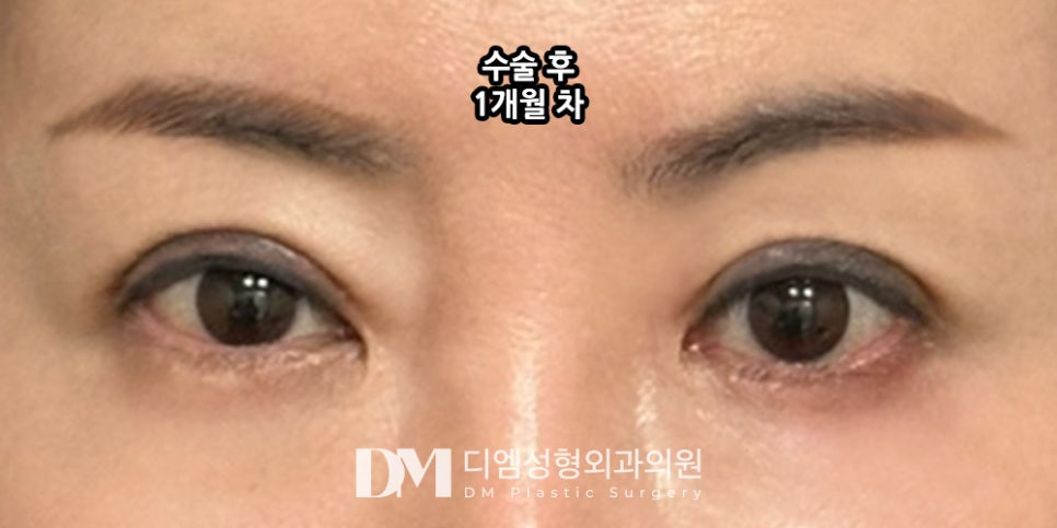 상안검, 처져 답답해 보이는 눈매 개선하기 관련 이미지 12