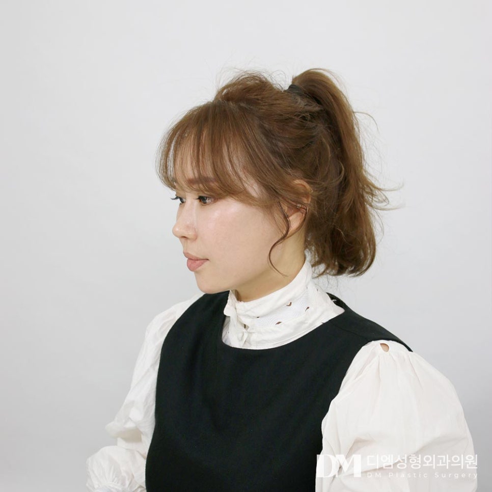 반거상, 중안면부의 처짐과 팔자,입꼬리 주름 개선에 최고! 관련 이미지 1