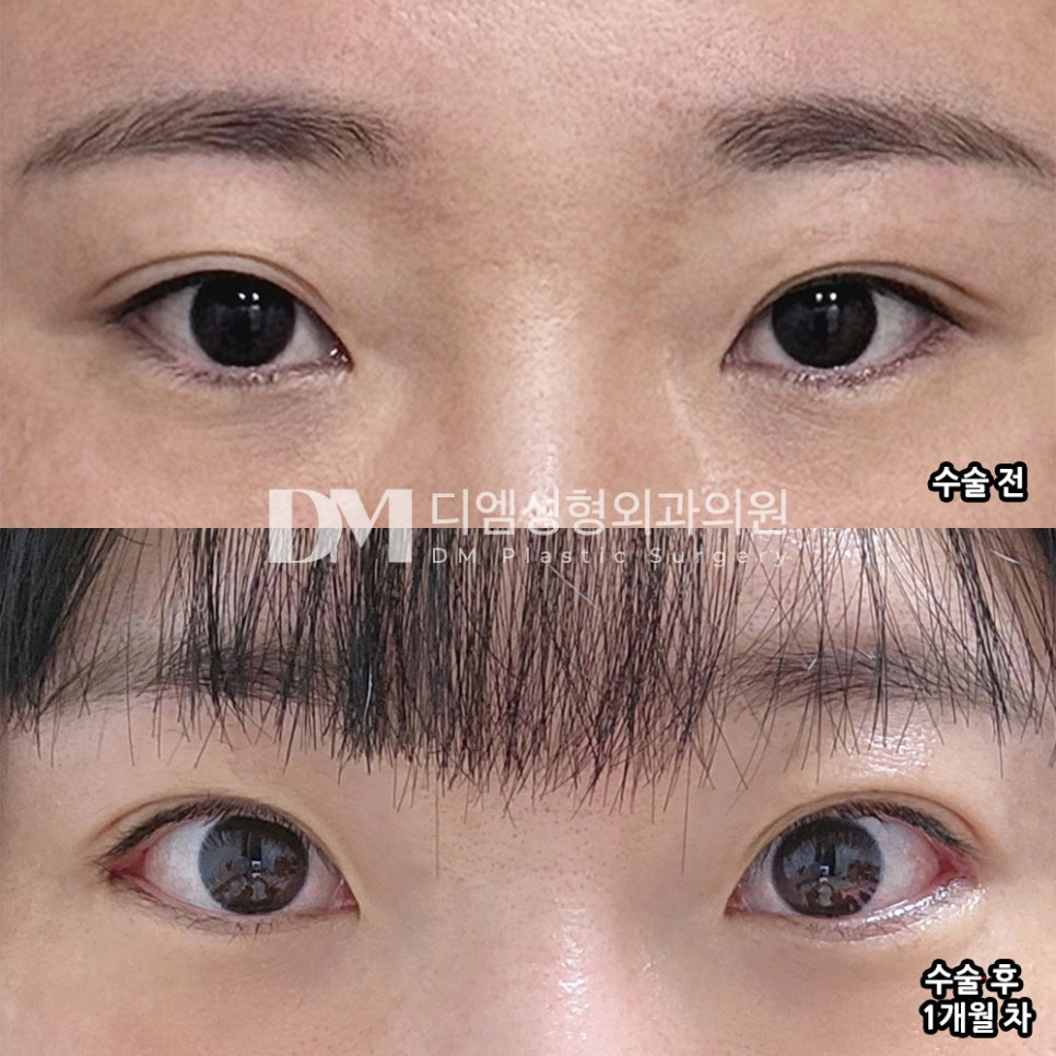 디엠 빵트임/뒤밑트임 후기, “대만족이에요! 고민했던 시간이 아깝습니다!” 관련 이미지 2