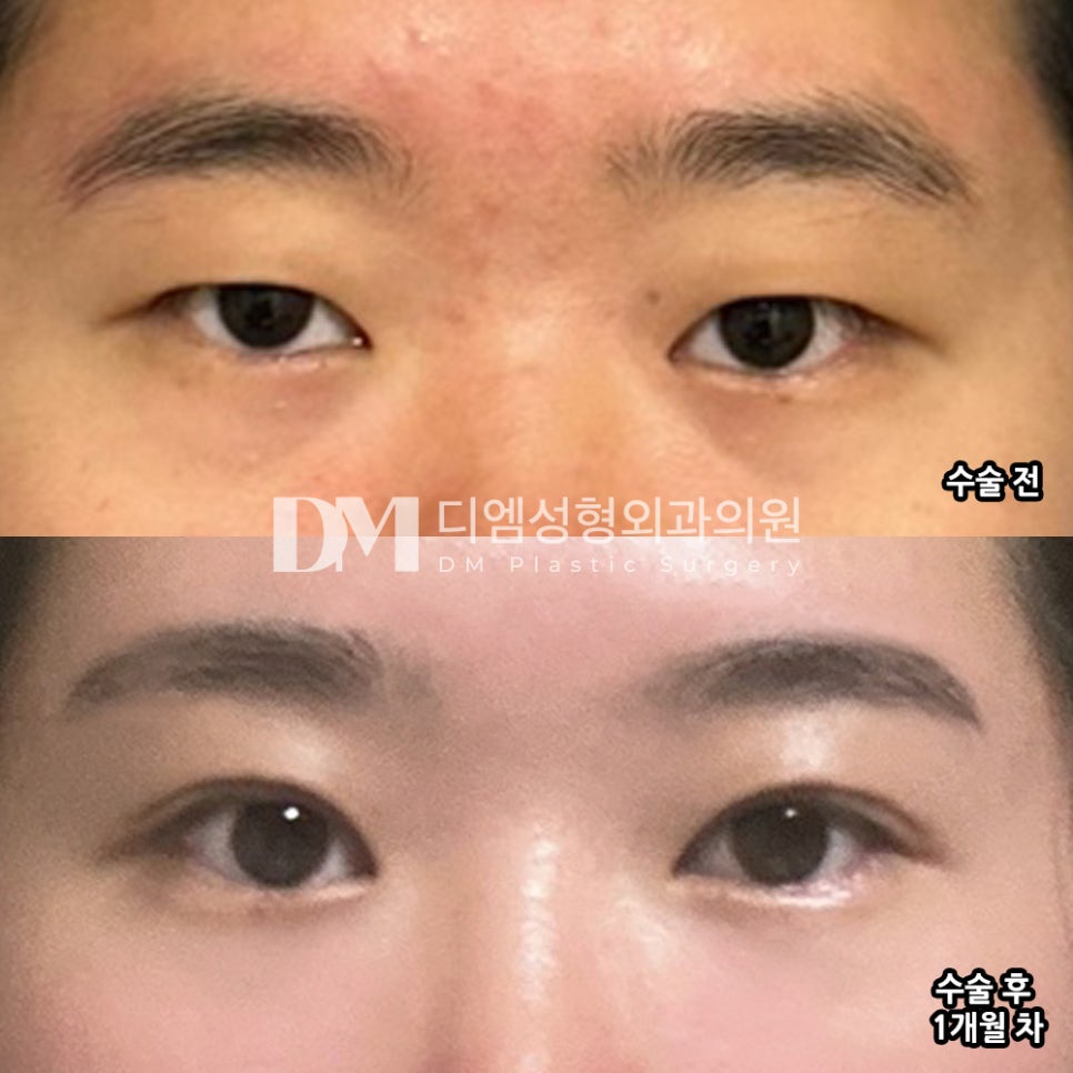 Eye Surgery Review. "I’m happy with both the procedure and the results!" image 2