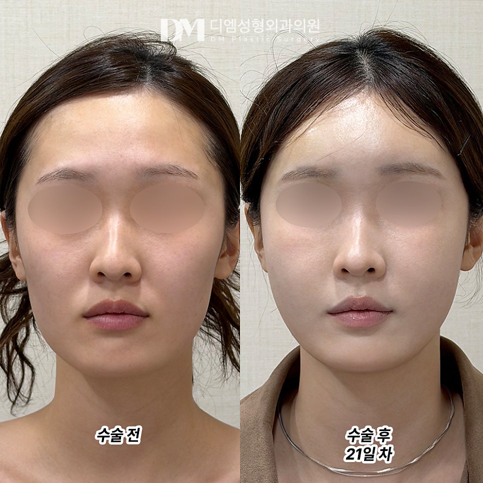 디엠 얼굴지방이식 후기, “자연스럽게 차올라서 너무 좋아요!” 관련 이미지 2