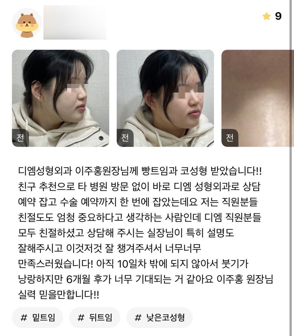 코성형 후기."직원 모두 친절하시고 6개월 후가 기대돼요!" 관련 이미지 1