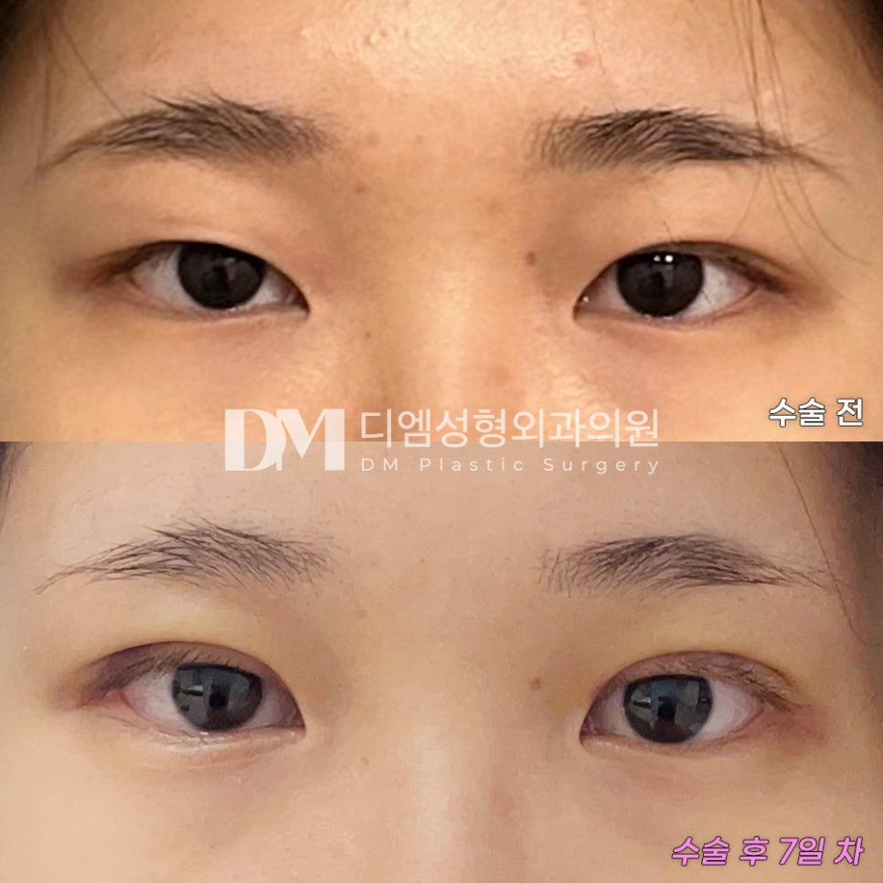 눈재수술 후기."니즈를 맞춰줘서 너무 감사하고 만족스러워요!" 관련 이미지 2