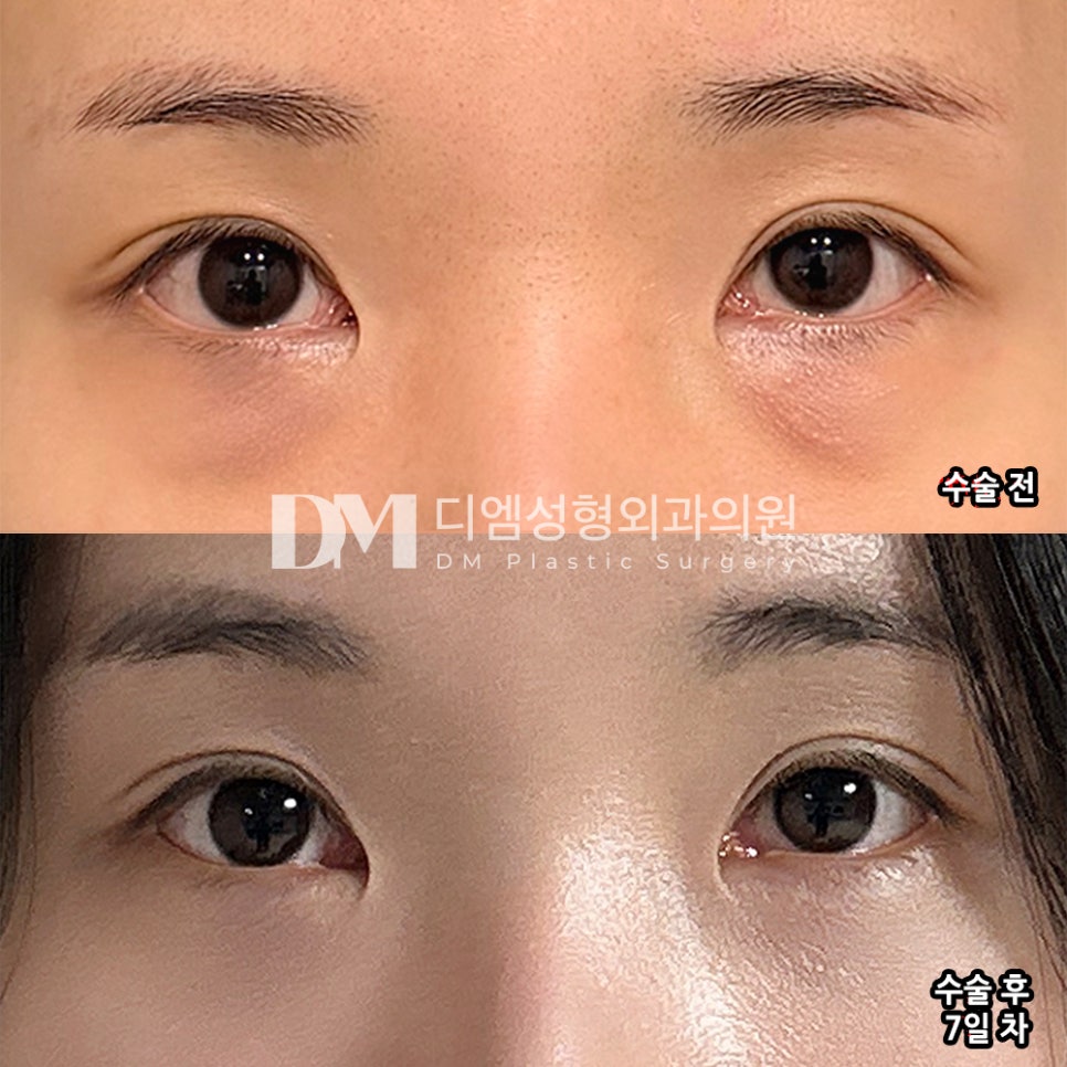 DM Lower Eyelid Fat Repositioning Surgery Review, “I was so satisfied to see it becoming smoother and more refined!” image 2