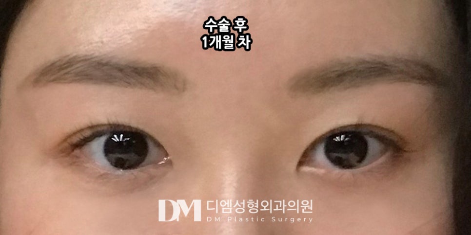눈매교정 , 힘없는 눈매를 또렷하고 선명하게! 관련 이미지 13