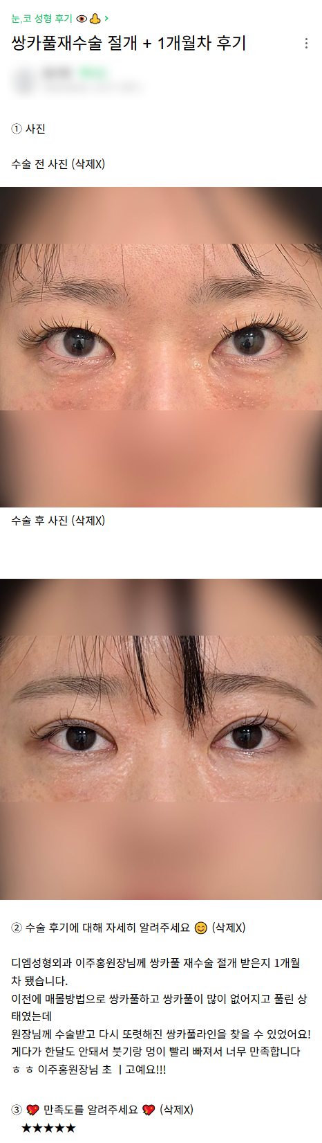 디엠 눈재수술 후기, “너무 만족합니다! 이주홍 원장님 최고예요!” 관련 이미지 1