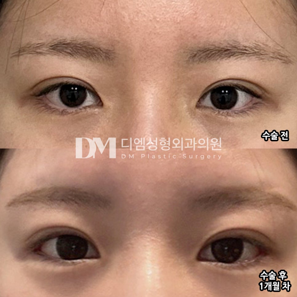 디엠 빵트임 수술후기, “멍도 안 들고 꼬맨 자국 티 안 나요!” 관련 이미지 2