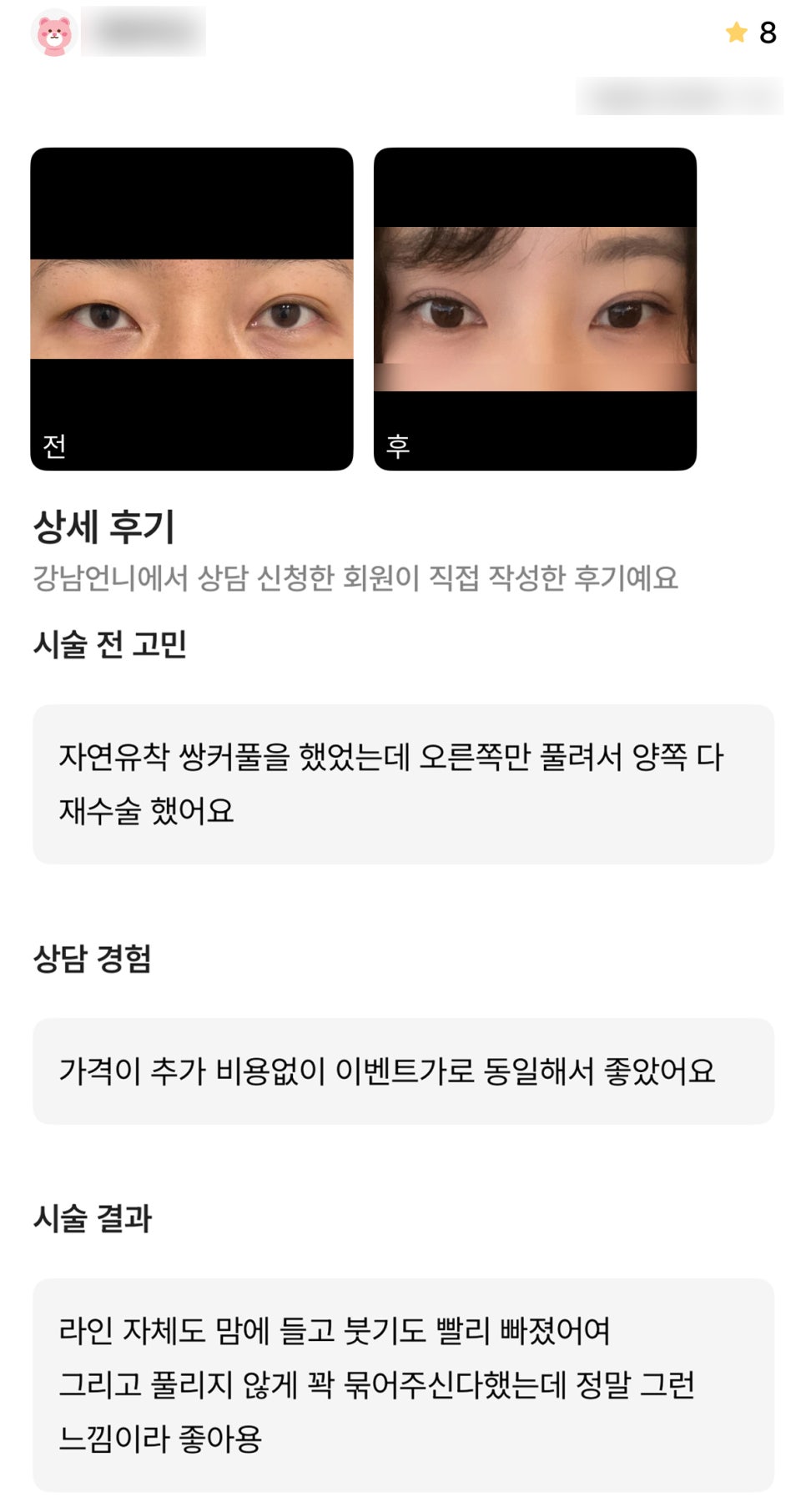 디엠 눈재수술 후기, &ldquo;라인 자체도 마음에 들고 붓기도 빨리 빠졌어요!&rdquo; 관련 이미지 1