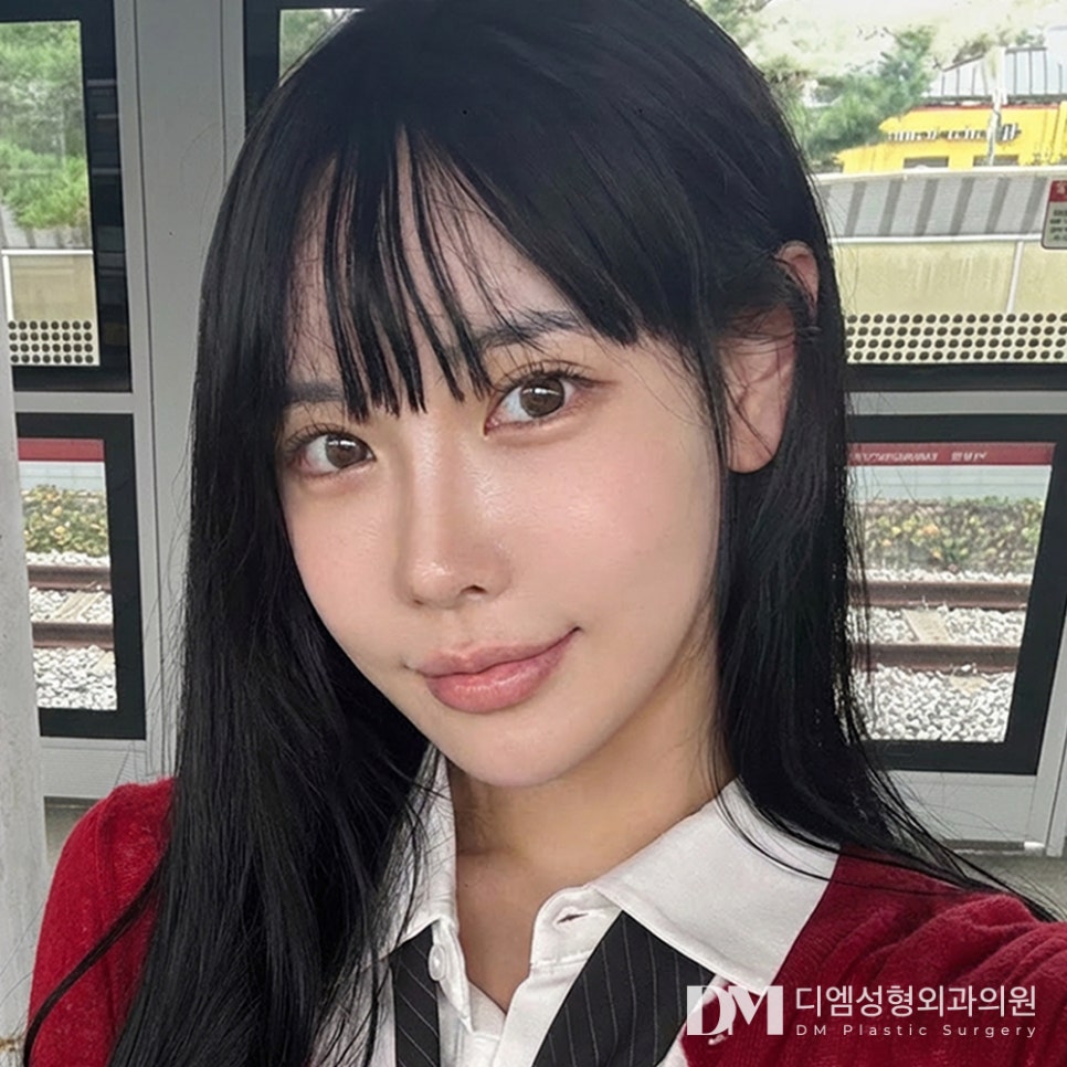 눈재수술 전, 반드시 알아야 할 핵심 포인트! 관련 이미지 2