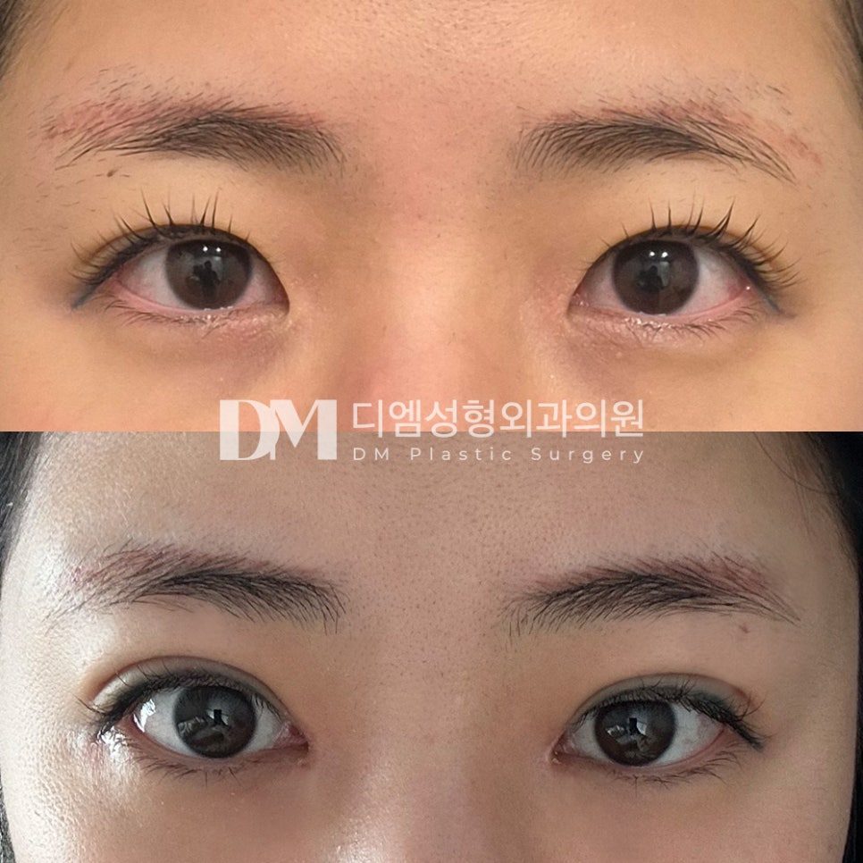 눈성형 후기."불편한 점도 없고 붓기가 잘 빠지고 있는거 같아서 만족 합니다 !" 관련 이미지 2
