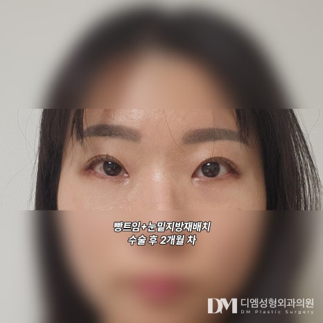 눈성형 후기."시간이 갈수록 자리 잡으니 만족스러워요!" 관련 이미지 3