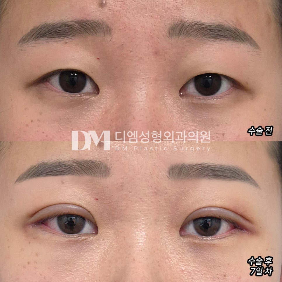 Eye Surgery Review. “I was worried because it was a revision surgery, but looking at the results, I think I worried for too long for nothing haha” image 2