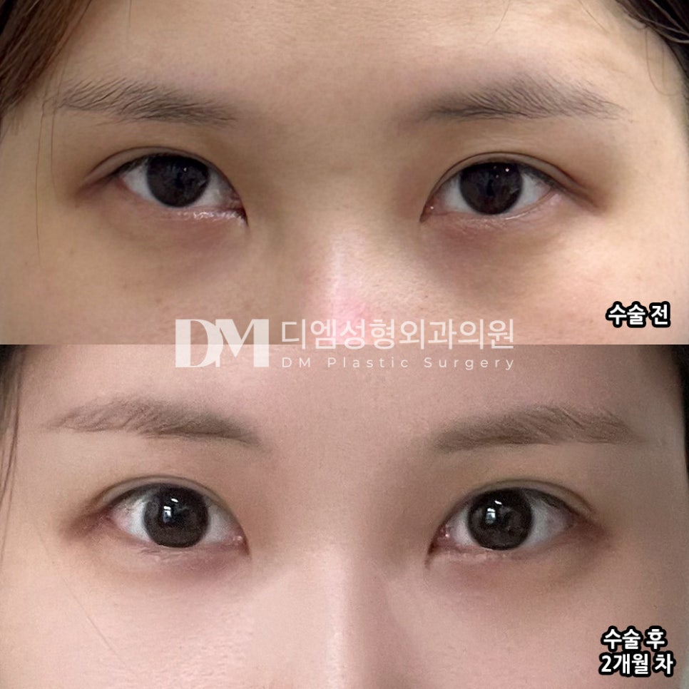 뒤밑트임, 답답하게 막힌 눈매 시원하게 개선하기 관련 이미지 5