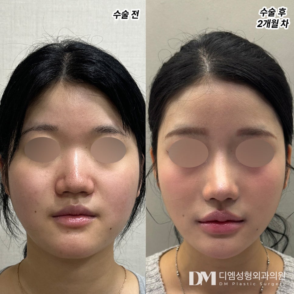 복코성형, 둔해보이는 인상에서 세련된 인상으로! 관련 이미지 10