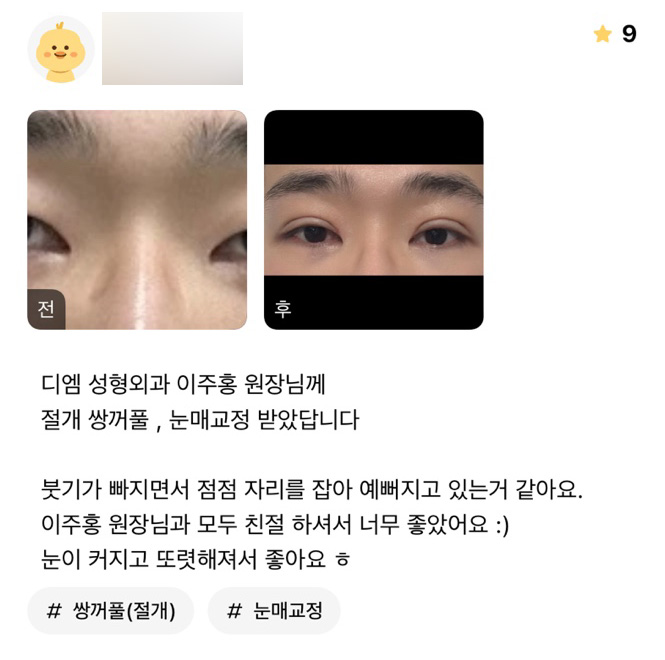 눈재수술 후기."눈이 커지고 또렷해져서 좋아요 ㅎ" 관련 이미지 1