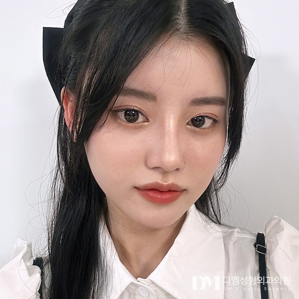 디엠 코성형 전후사진, 이목구비가 확 살아보이는 비결은? 관련 이미지 1