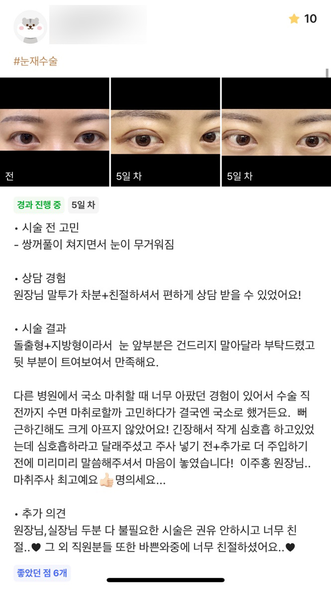 눈재수술 후기."뒷 부분이 트여보여 만족해요 !" 관련 이미지 1
