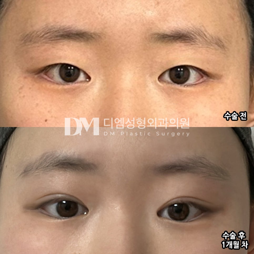 Eye Plastic Surgery Review. “I’m happy that it turned out as naturally as I imagined!” image 2