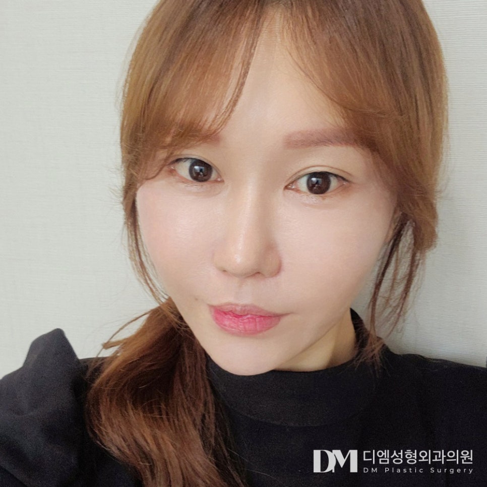 흉터 걱정 줄인 3040 리프팅, 디엠 반거상 수술방법은? 관련 이미지 1