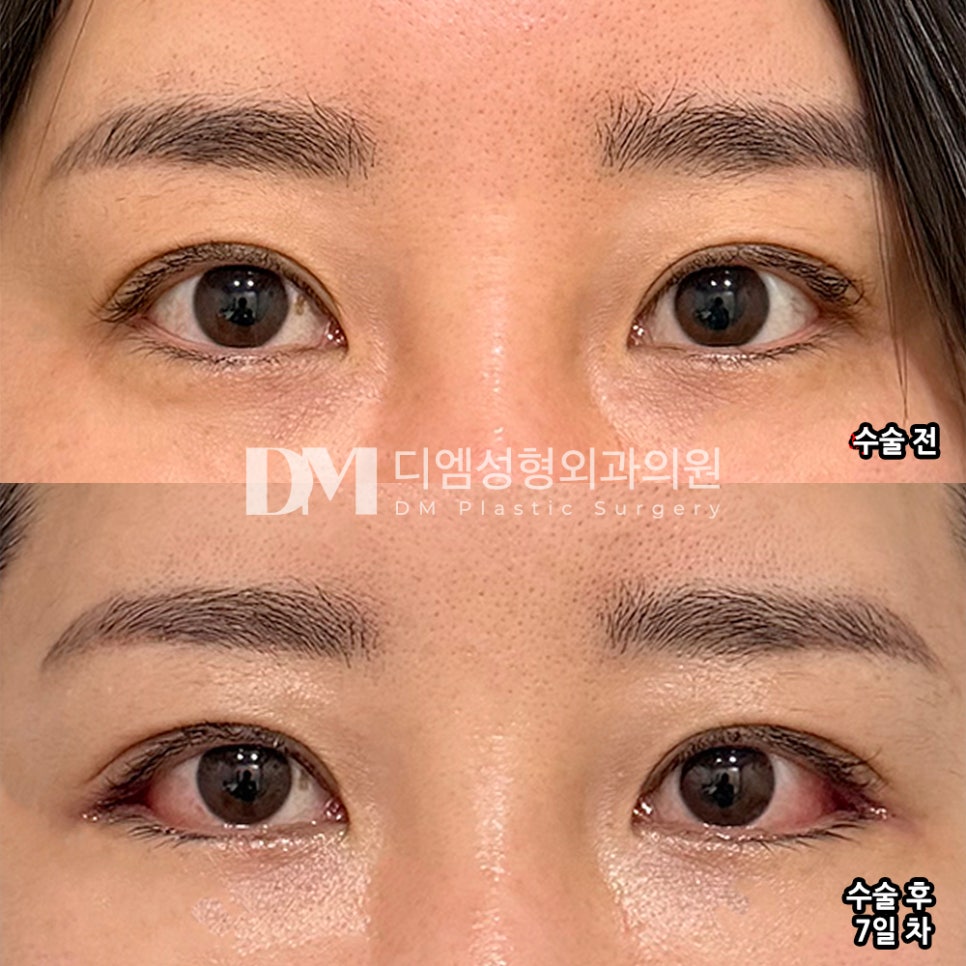 디엠 빵트임 수술후기, “완전 다른 눈이 된 거 같아요! 후회 안 합니다!” 관련 이미지 2