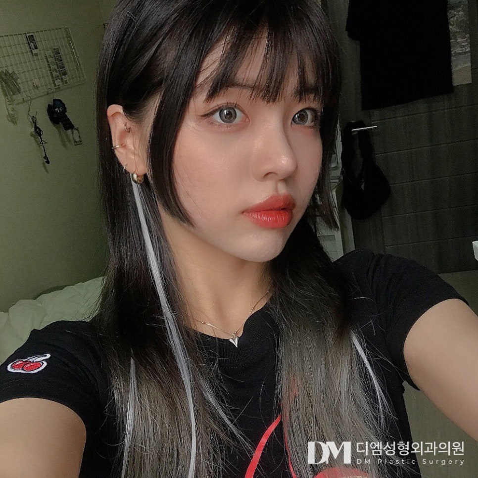 긴코,화살코 성형 나이들어보이던 코 교정하기 관련 이미지 10