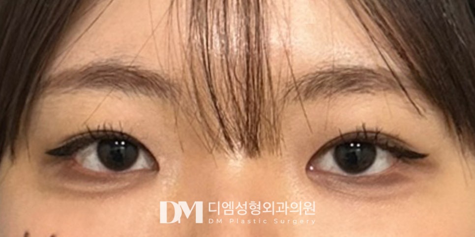 Eye-Shape Correction Combined with Double-Eyelid Surgery for More Defined Eyes! image 13