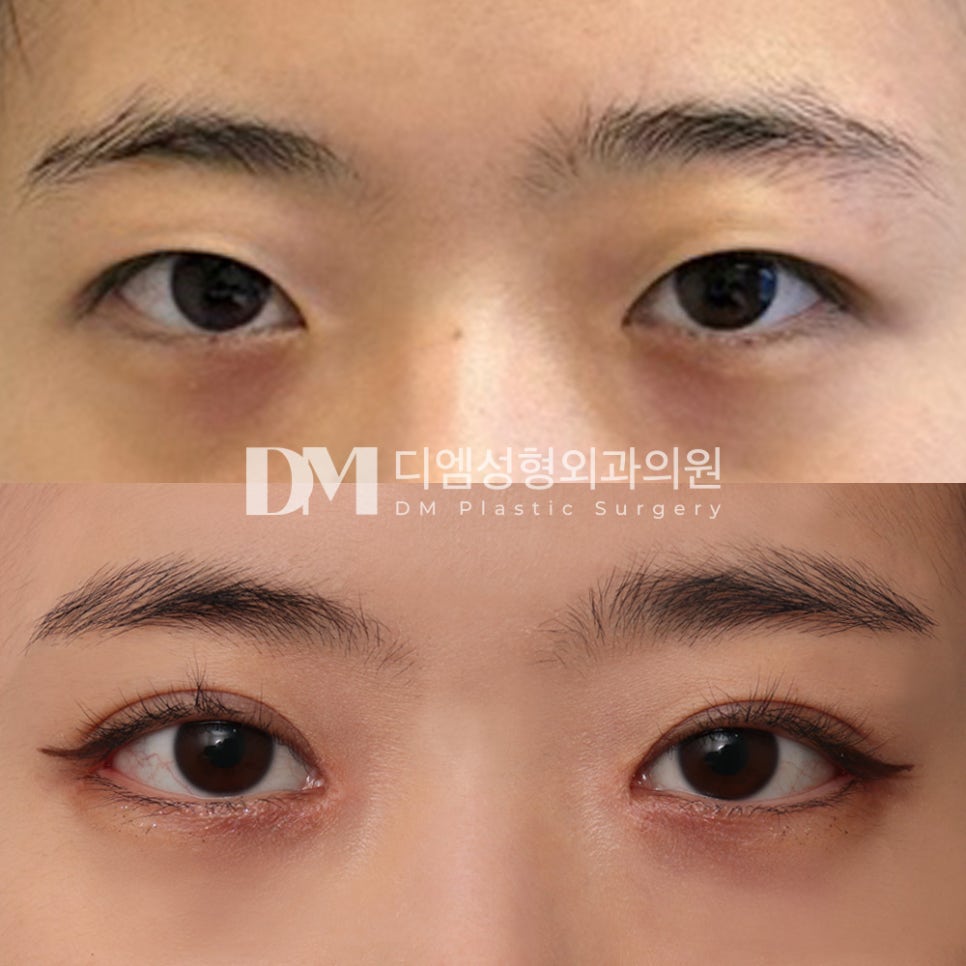 눈성형 후기."눈이 점점 자연스럽게 예뻐지는게 느껴져서 너무 만족이에요!" 관련 이미지 2