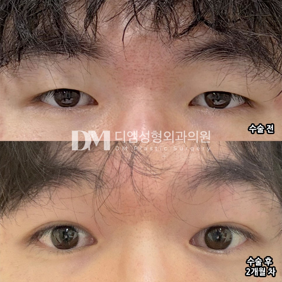 디엠 남자눈매교정/남자눈성형 후기, “눈 예쁘다는 소리 많이 들어서 기분 좋습니다!” 관련 이미지 2