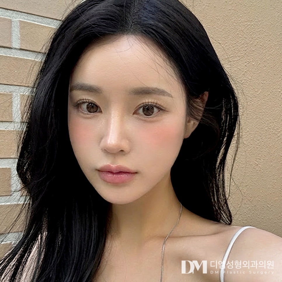 Before-and-After Photos of DM Lateral and Lower Canthoplasty: What’s the Secret to Solving Concern About a Fierce, Heavy-Looking Eye Shape? image 1