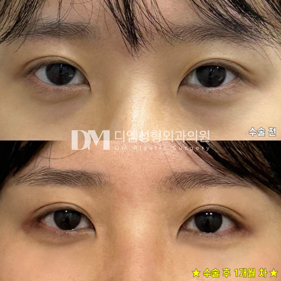 뒤밑트임 후기."빠르게 자연스러워져서 좋습니다" 관련 이미지 2