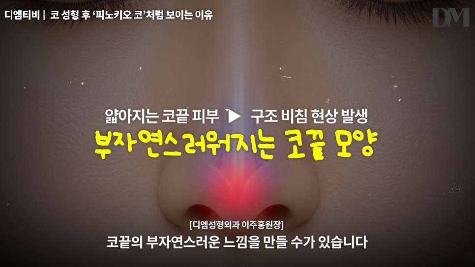 코성형 후 피노키오 코처럼 보이는 이유, 코가 높아서일까요? 관련 이미지 6