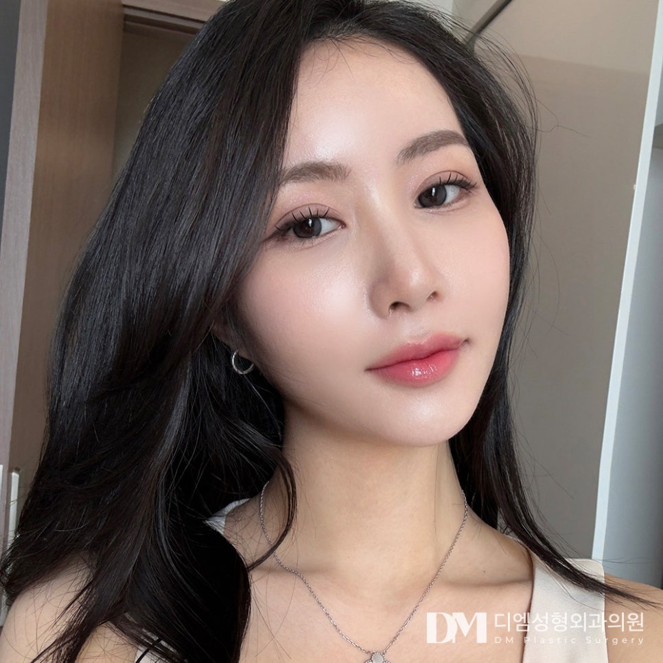 쌍꺼풀수술, 내게 맞는 방법으로 인상 개선하기 관련 이미지 14