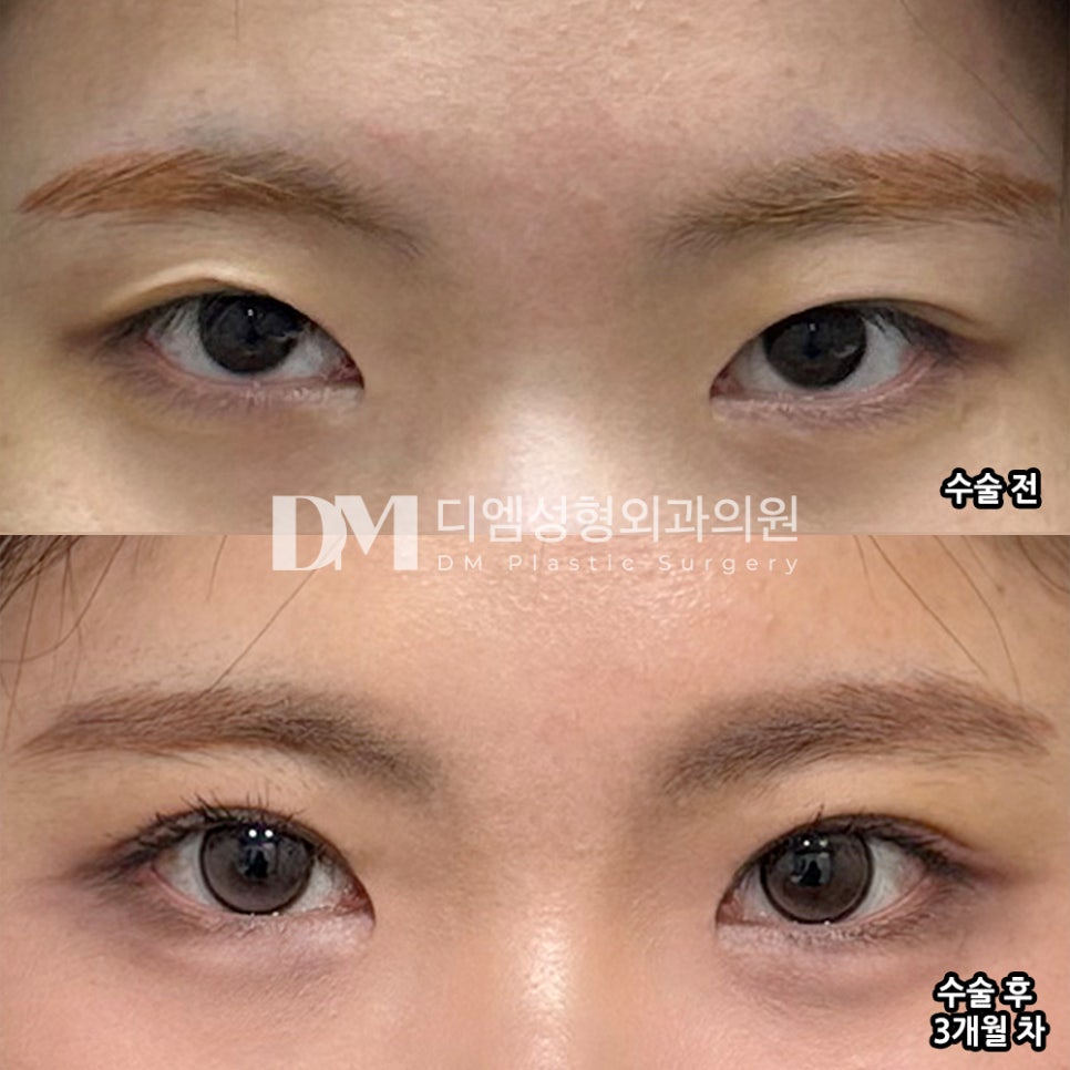 디엠 눈재수술 후기, &ldquo;고민하던 부분을 해결해 주셔서 너무 만족스러워요!&rdquo; 관련 이미지 2
