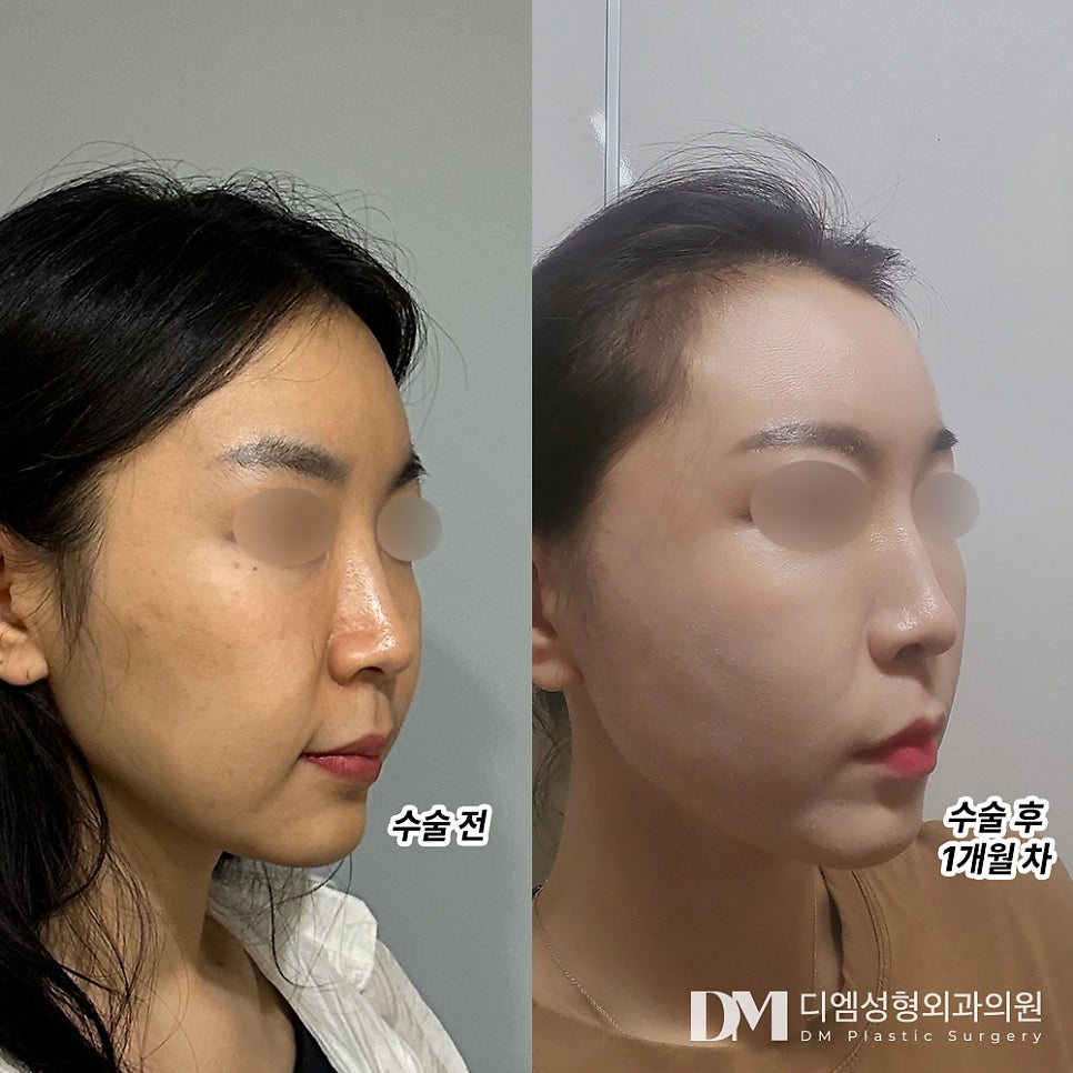 Mini Facelift Review. “More Satisfying Than Laser!! I Recommend It” image 2