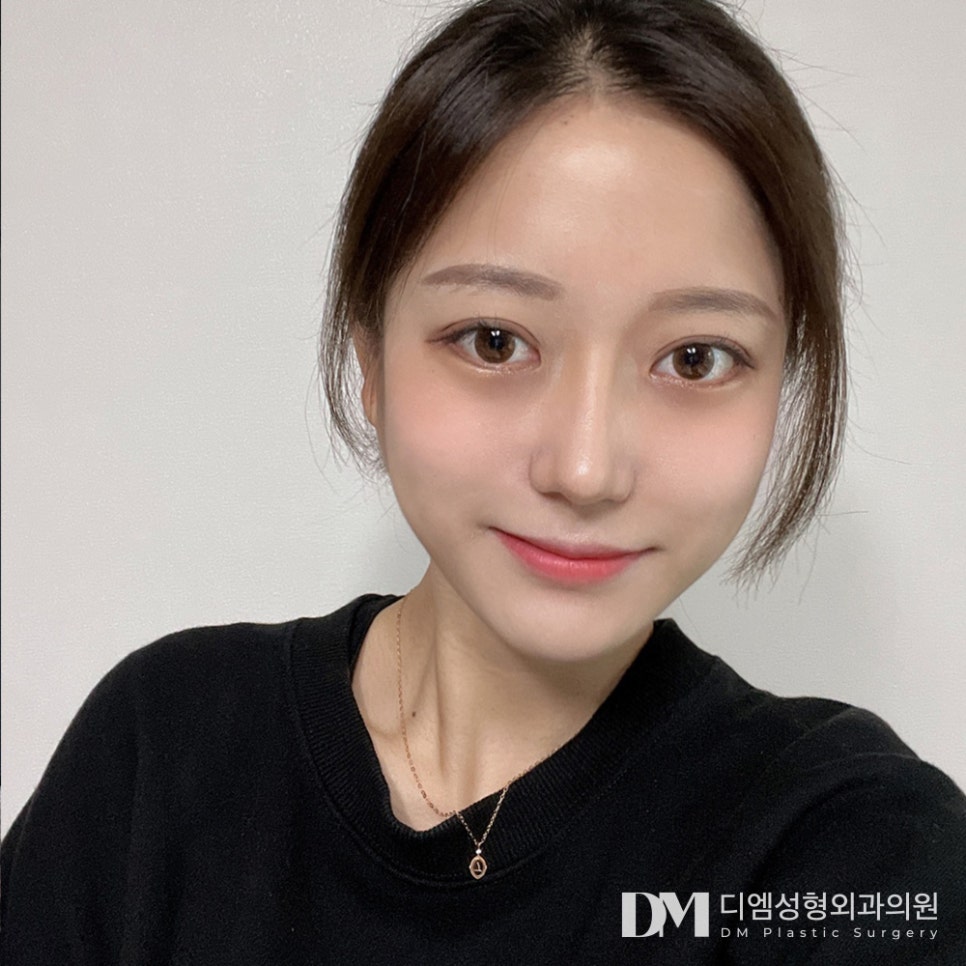 눈매교정 , 힘없는 눈매를 또렷하고 선명하게! 관련 이미지 16