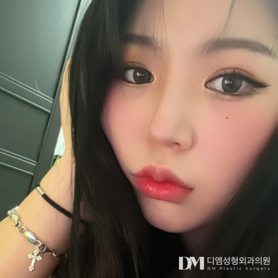 Bbangtwin: Back corner and lower corner eye surgery at the same time! image 1