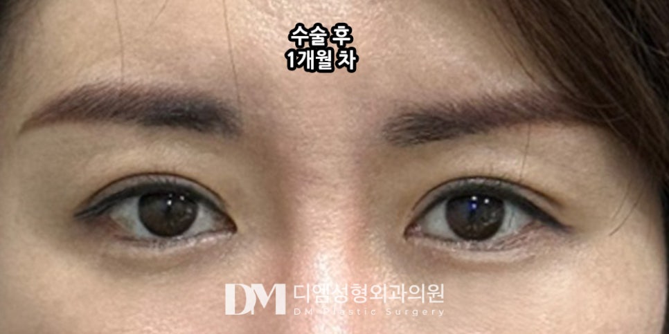 눈재수술, 실패의 흔적을 지우고 새롭게 시작하기 ! 관련 이미지 9