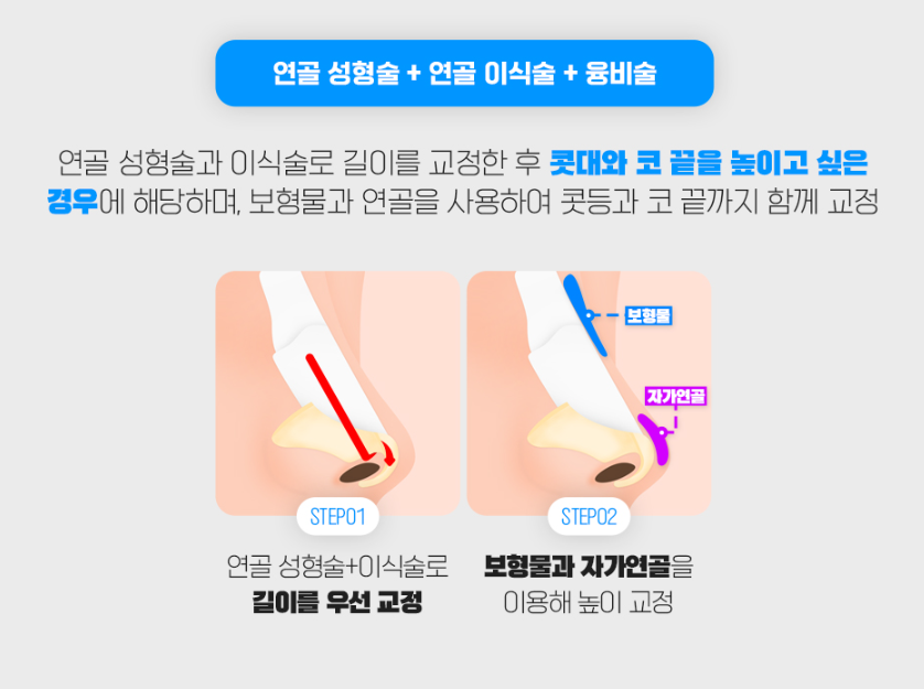 짧은코성형, 무조건 늘리고 높이기 보다 자연스럽게 맞춤형으로! 관련 이미지 7
