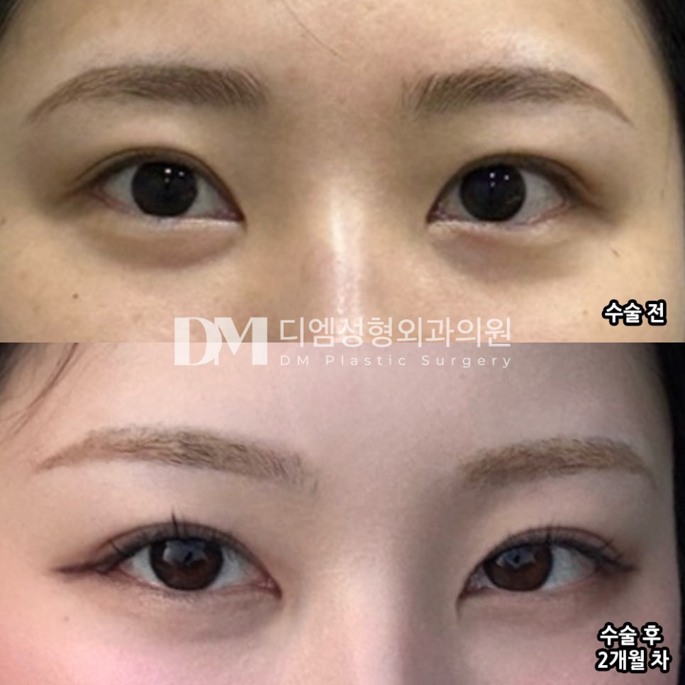 빵트임 후기."회복도 빨라서 오래 고민한 시간이 아까움! " 관련 이미지 2