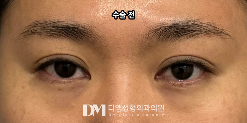 눈밑지방재배치, 칙칙하고 피곤해보이는 인상을 개선하려면?! 관련 이미지 6