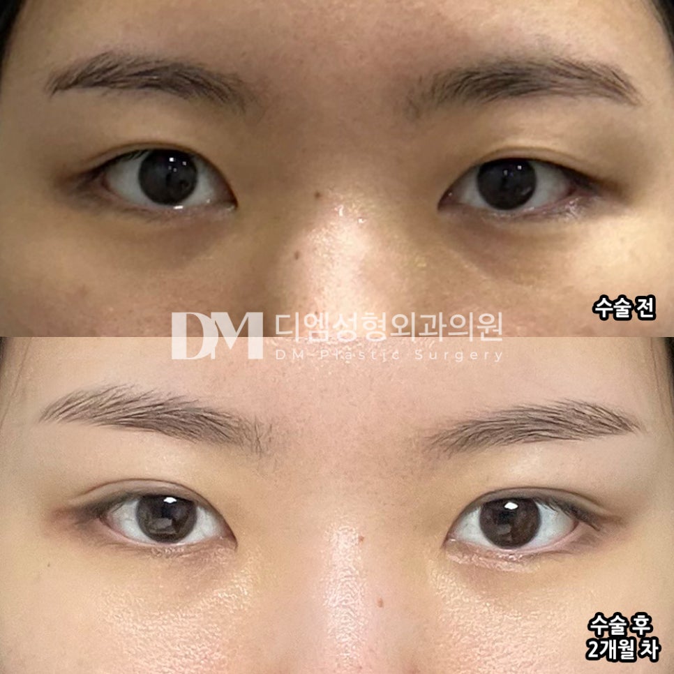 Eyelid Revision Surgery Review. "I liked the sincerity of the director, and I am also satisfied with the results!" image 2