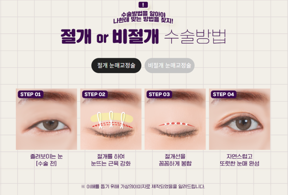 눈매교정, 피곤해보이는 인상 탈출하기 관련 이미지 9
