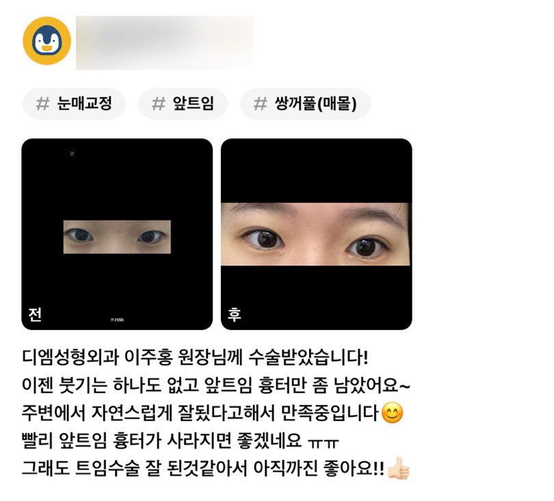 눈성형 후기."주변에서 자연스럽게 잘 됐다고 해서 만족중입니다 😊!" 관련 이미지 1